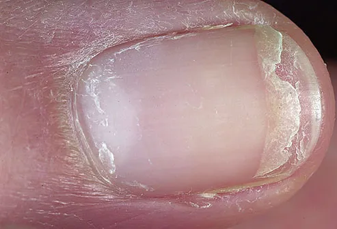 Cracked, Brittle & Splitting Fingernails; Dermatologist's Tips