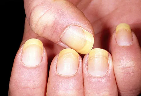 Yellow fingernails on a woman's hand