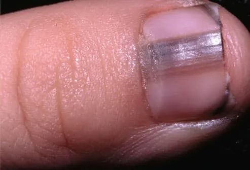 Dark lines beneath the nail