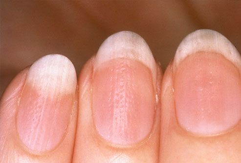 What Causes Ripples In Your Toenails