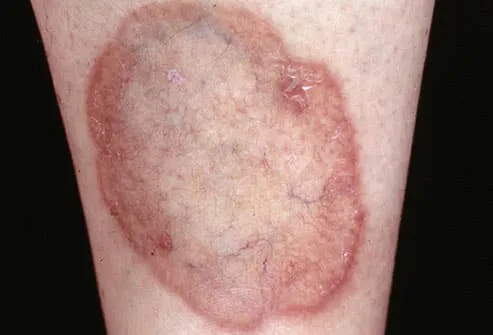 Dry Patch On Skin Leg
