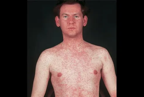 Early Symptoms Of Measles In Adults