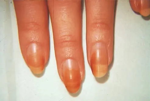 Picture of Discoloration of Nail Plates