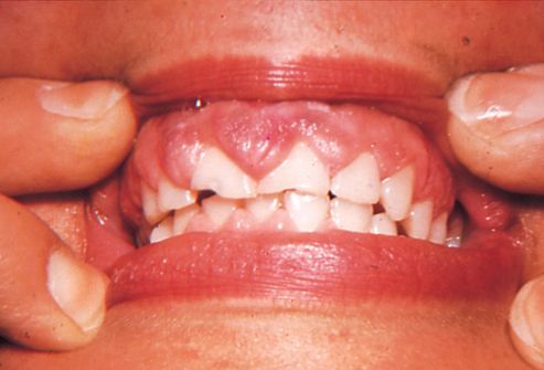 Hyperplasia Of The Gums. Gingival hyperplasia from