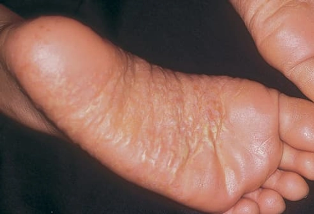 Psoriasis of Hands and Feet (including Palmoplantar ...
