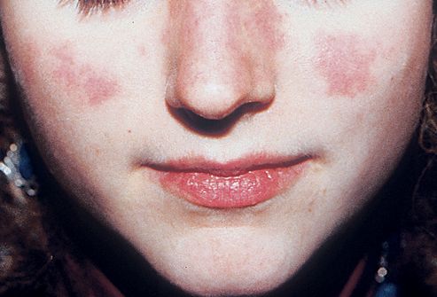systemic poison ivy pictures. Picture of Systemic Lupus