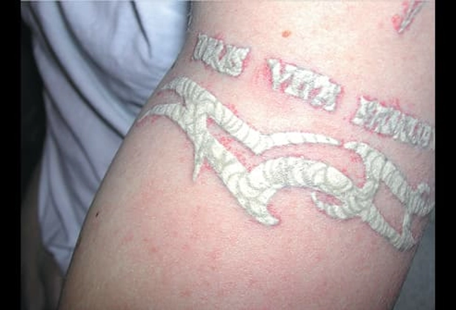 Picture of Tattoo with Q-Switched Laser Treatment