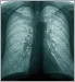 lung xray