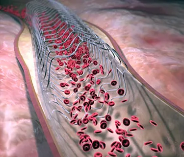 Are heart stent procedure videos available to watch online?