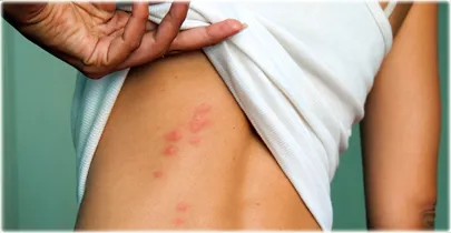 Bedbugs Quiz: Bites, Infestations, Getting Rid of Bedbugs