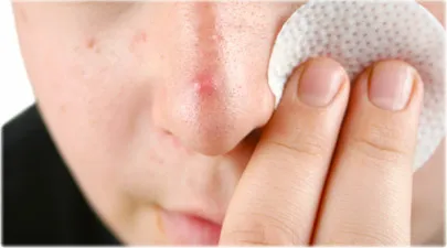 Clogged Pores On Dogs Skin