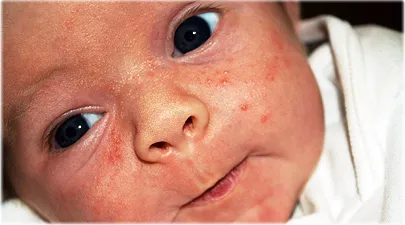 Acne In Babies