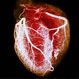 Heart Disease Overview Slideshow