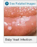 Thrush Yeast Infection