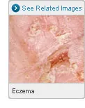 Picture of Eczema
