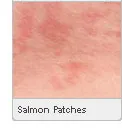 ruam bayi: Salmon Patch