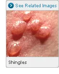 shingles skin rash