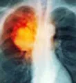 lung cancer overview slideshow