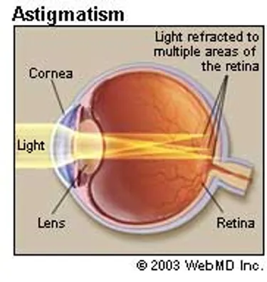 astigmatism and myopia together