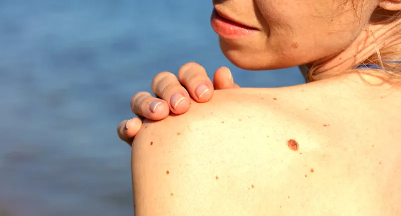 woman looking at moles on her shoulder
