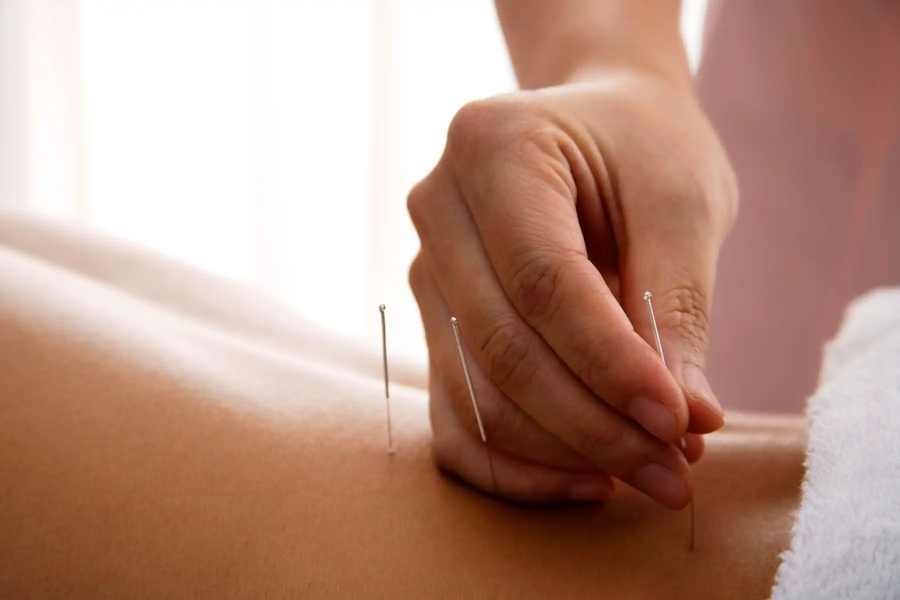 photo of placing acupuncture needles in back