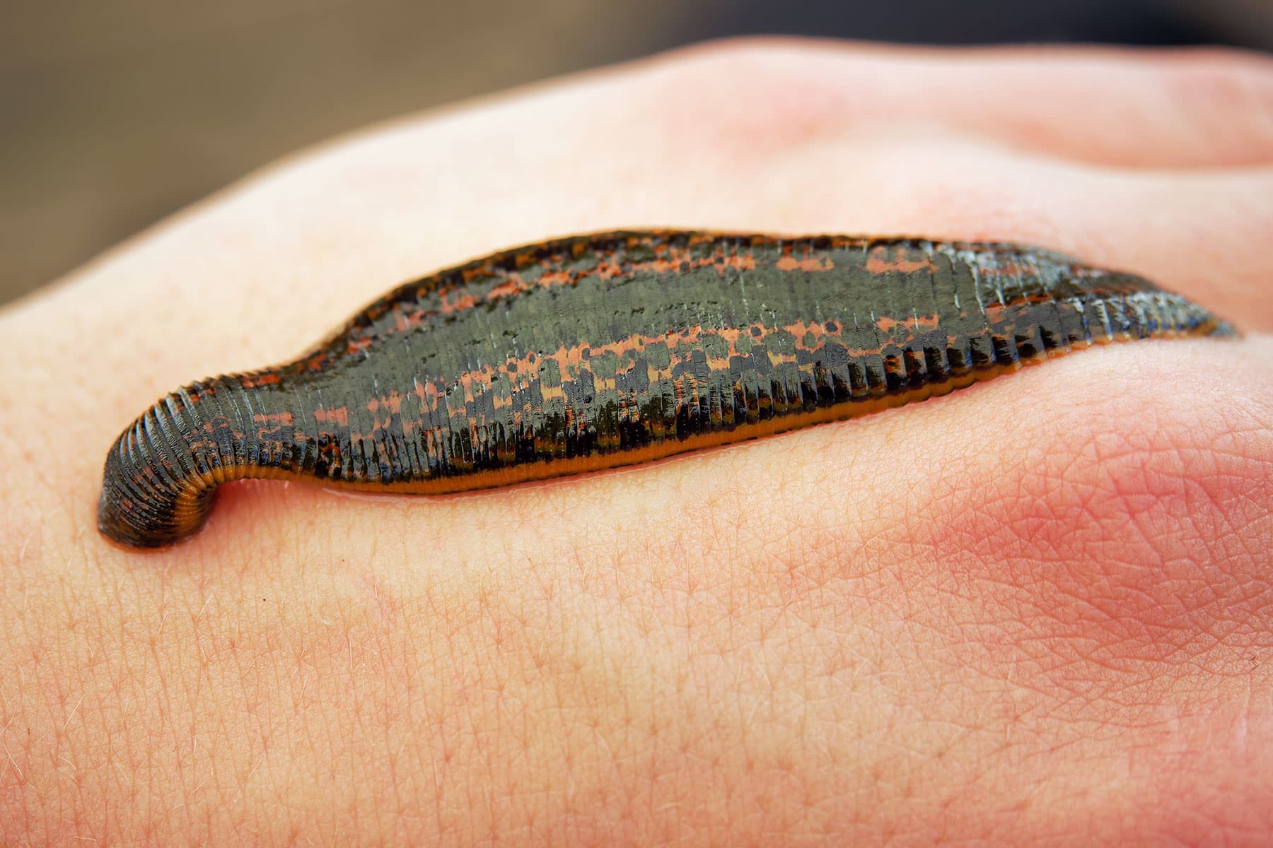 Blood-Sucking Leeches: Quack Medicine or Medical Miracle?