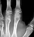 Hand bones X-ray