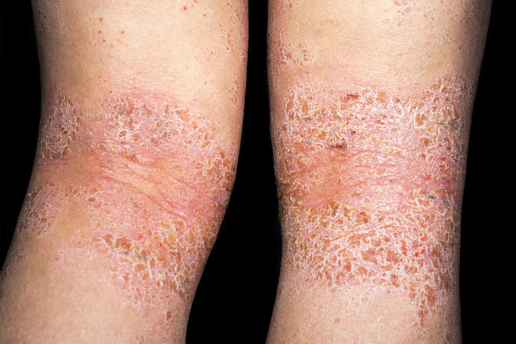 photo of atopic dermatitis behind knees
