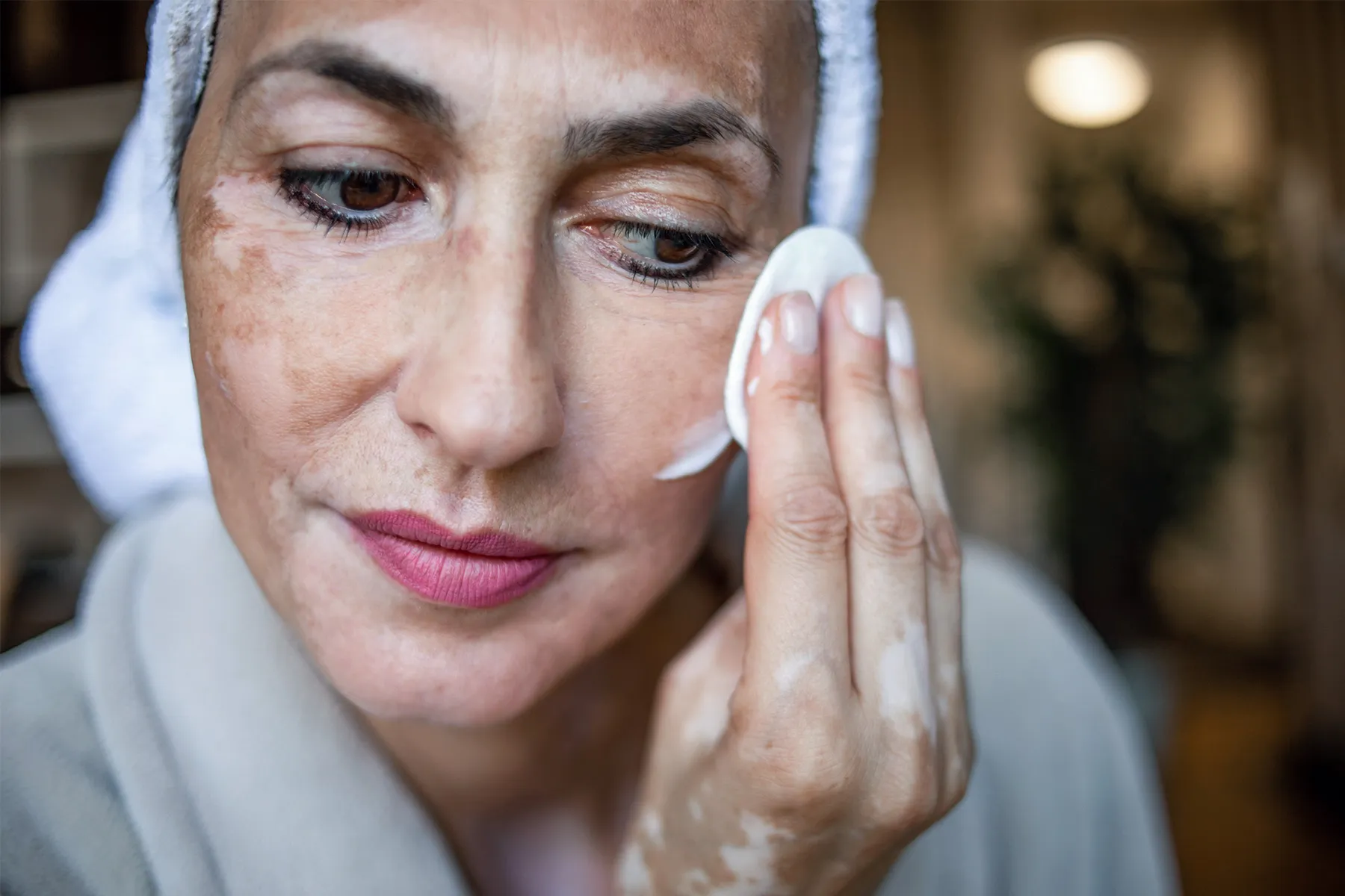 photo of woman with vitiligo applying face cream