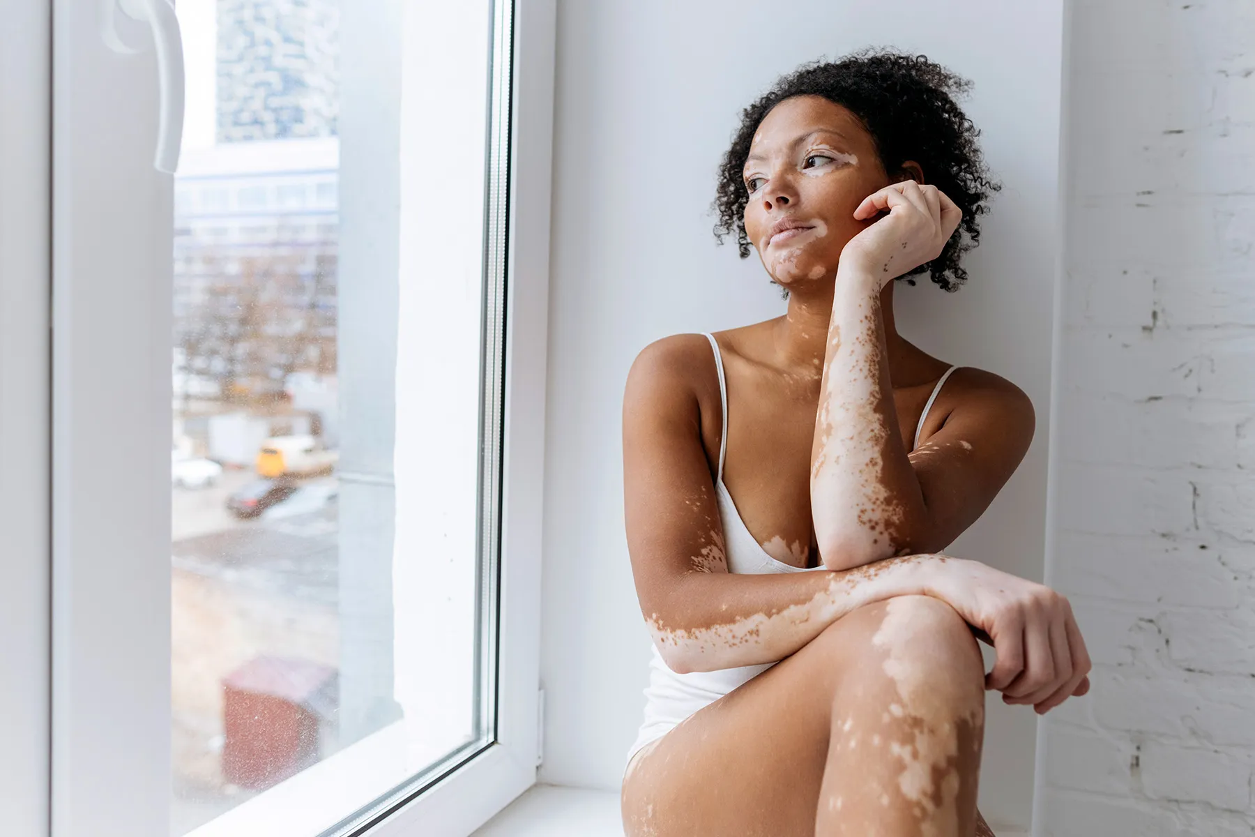 photo of woman with vitiligo looking out window