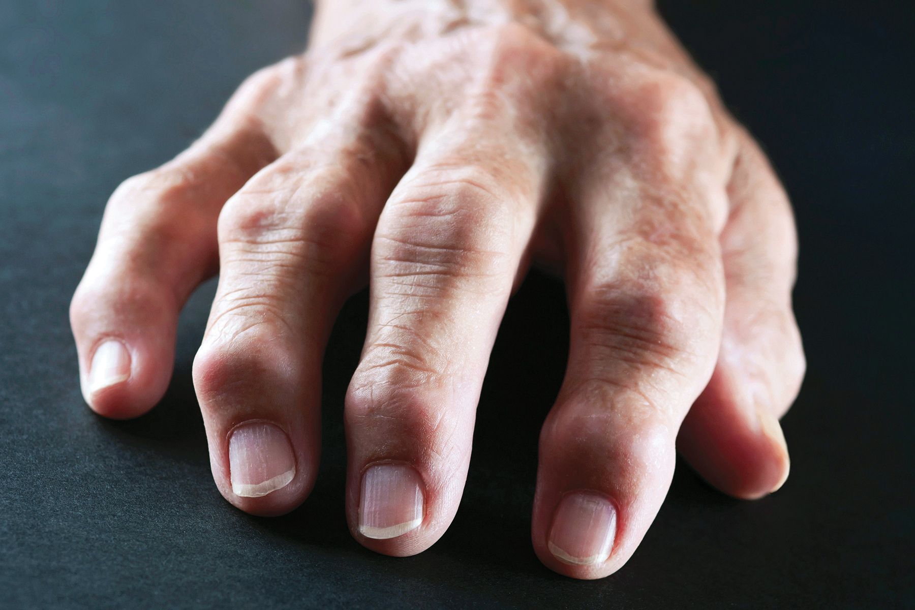 Doctors Strive for Quicker Diagnosis of Rheumatoid Arthritis