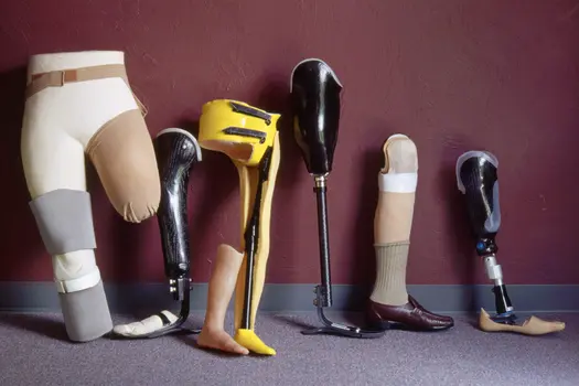 photo of lower limb prosthetics