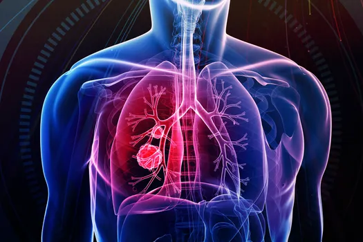 photo of lung cancer concept