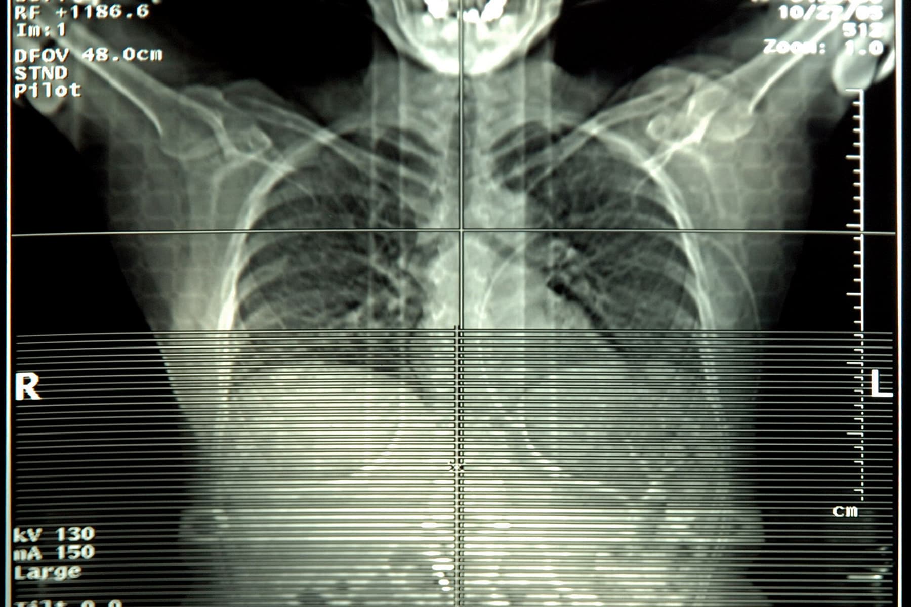 lung x-ray