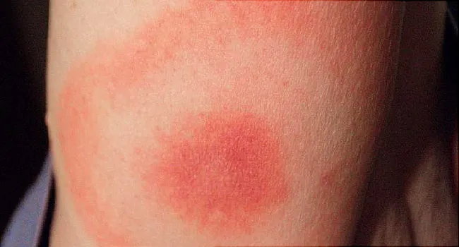Image result for Lyme disease