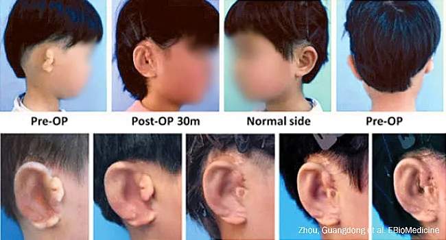 chinese children regrown ears story