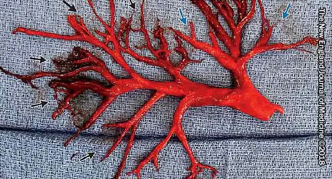 lung-shaped blood clot