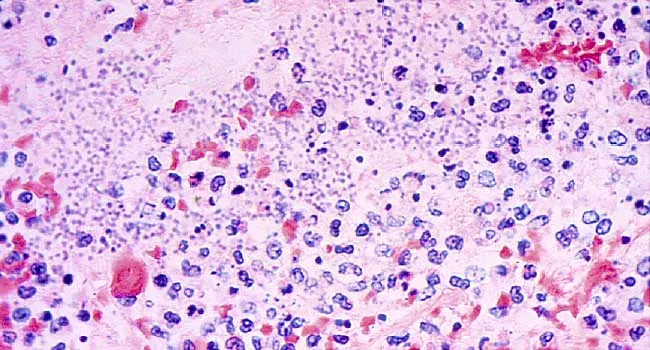 Giardia u deti - Giardia intestinalis zajímavý střevní prvok