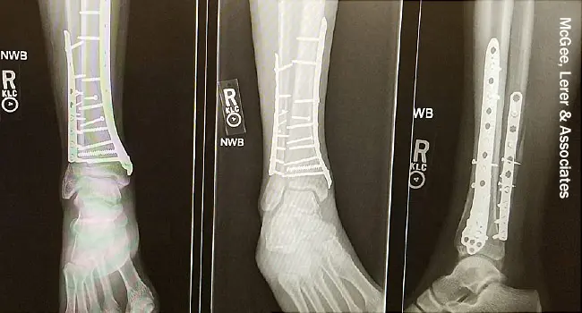 photo of Xray of injured leg