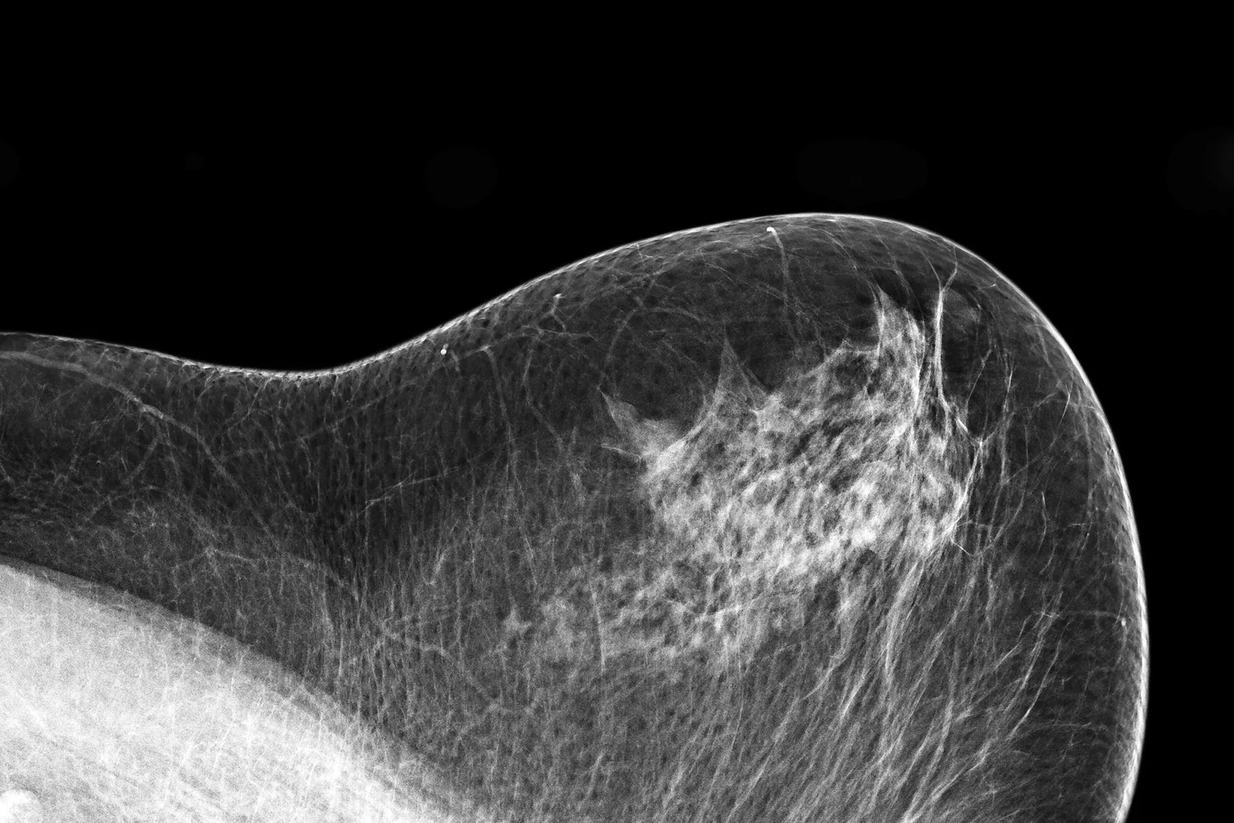 mammogram X-ray