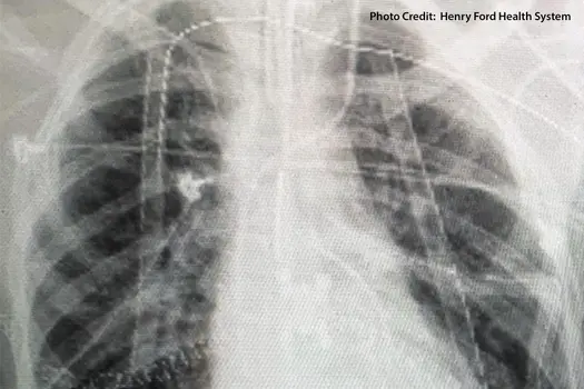 vaping double lung transplant x-ray