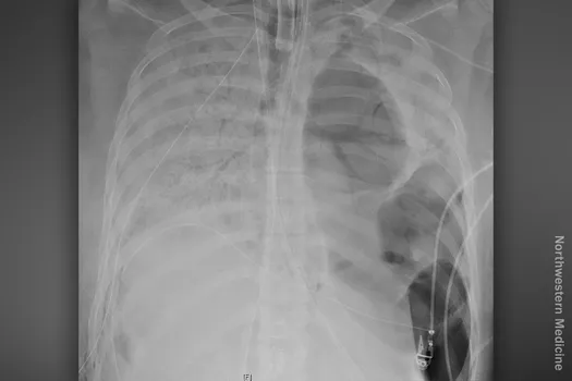 xray of lung of covid19 patient