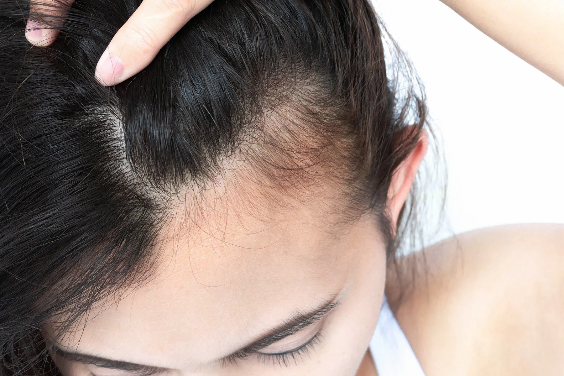 Hair Regrowth Stimulated by Microneedle Patch