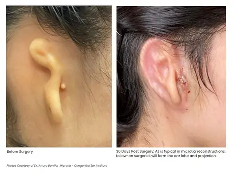 photo of 3D bio-printed ear