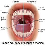 Human papillomavirus throat. Human papillomavirus mouth and throat cancer