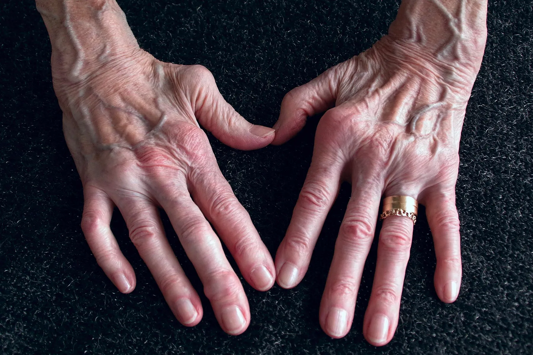 Secondhand Smoke May Raise Kids’ Rheumatoid Arthritis Risk