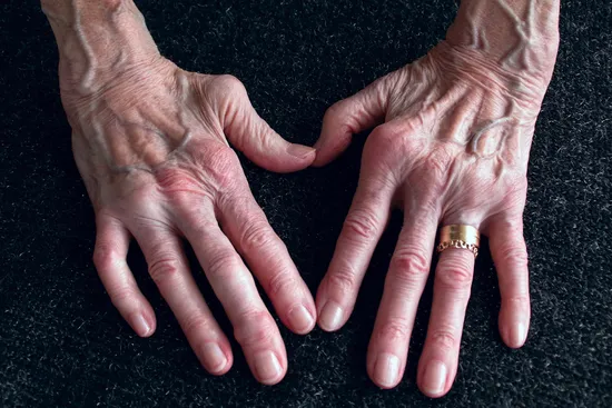 photo of rheumatoid arthritis