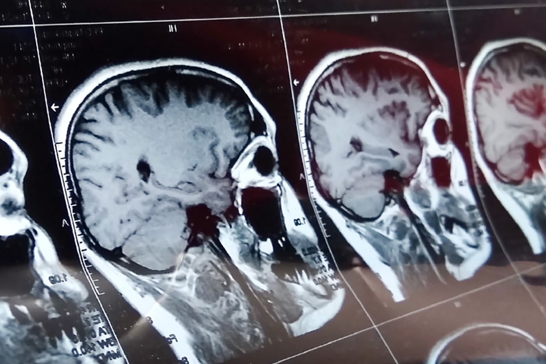 photo of medical photo scan head brain xray
