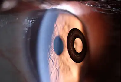 kamra corneal implant ring