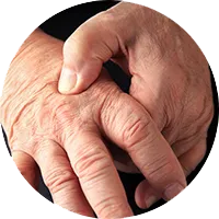 photo of arthritic hands